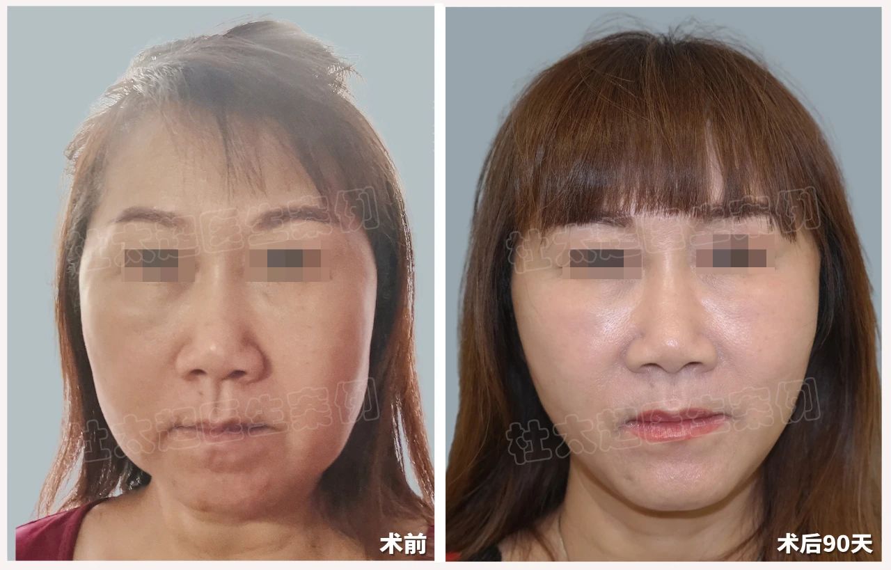 告别"馒化"大妈脸，拥抱紧致青春颜！54岁女士的惊人蜕变，您也能拥有！