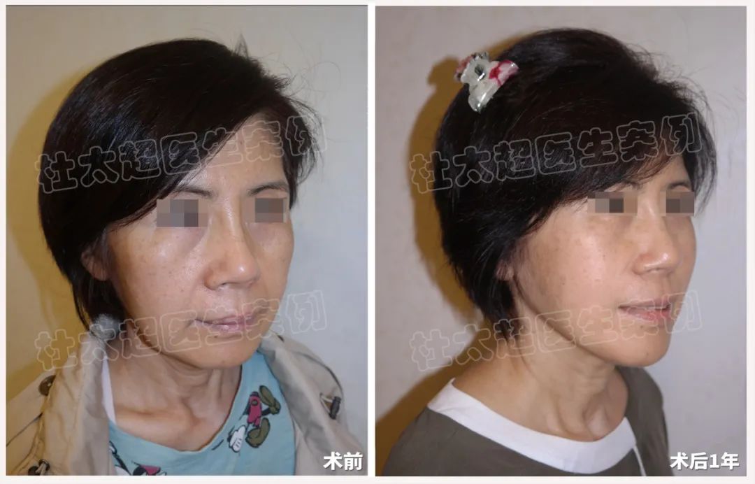 翻转岁月：64岁女士拉皮手术术后1年前后对比！