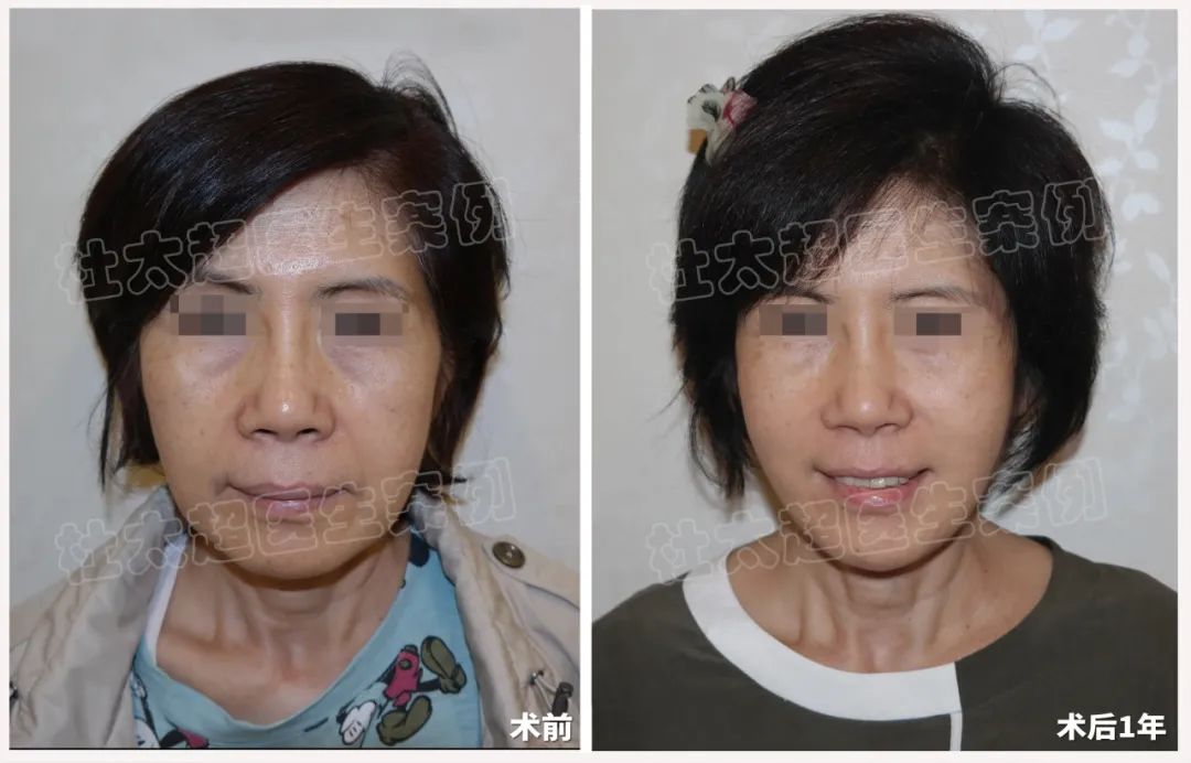 翻转岁月：64岁女士拉皮手术术后1年前后对比！