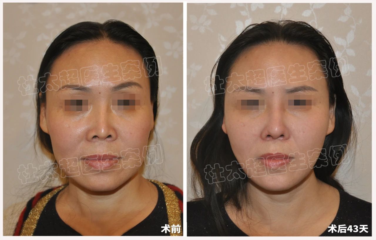 拉皮手术真的有效果吗？遇见杜太超教授，解锁50+女性逆龄新篇章！