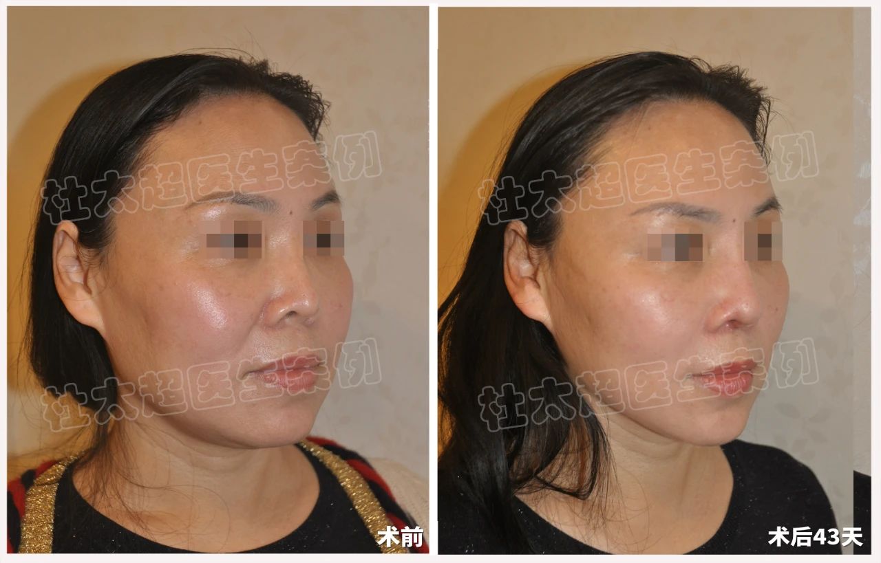 拉皮手术真的有效果吗？遇见杜太超教授，解锁50+女性逆龄新篇章！