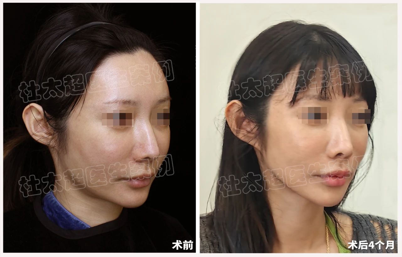 大曝光！39岁不再是年龄界限！拉皮术后4个月对比！