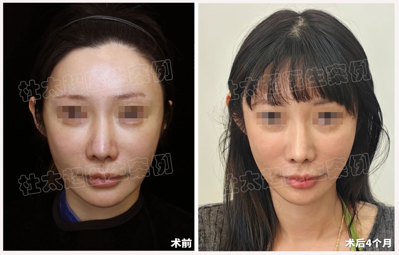 大曝光！39岁不再是年龄界限！拉皮术后4个月对比！