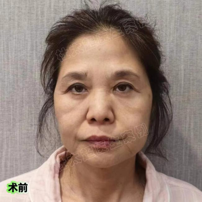 61岁公开自己拉皮效果，网友都说做对了！