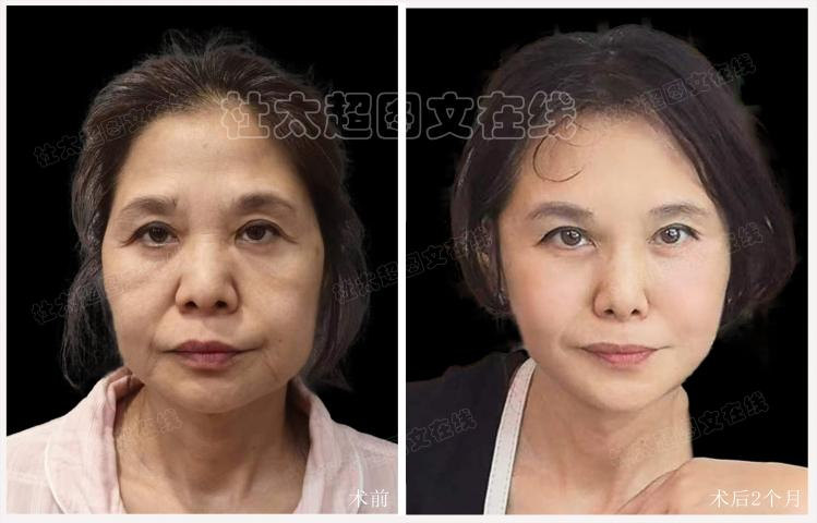 61岁公开自己拉皮效果，网友都说做对了！