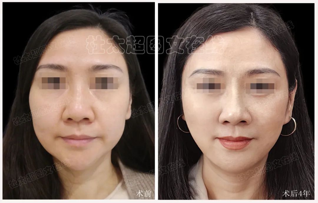 奇迹再现？拉皮手术背后的秘密，术后4年连自己都认不出了！