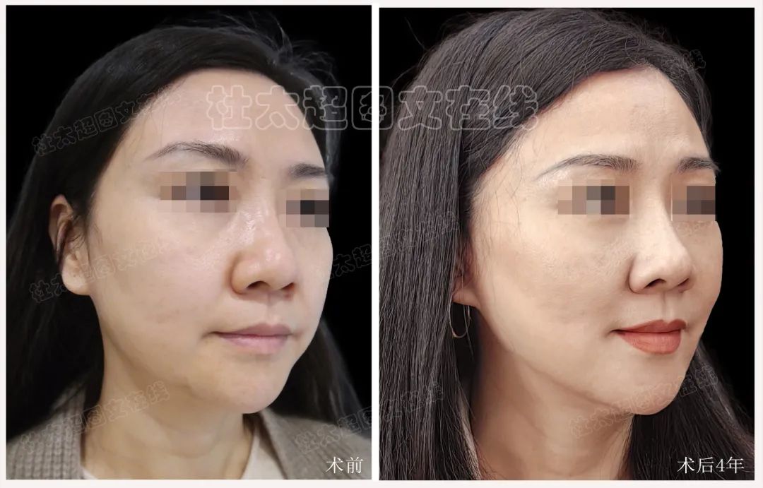 奇迹再现？拉皮手术背后的秘密，术后4年连自己都认不出了！