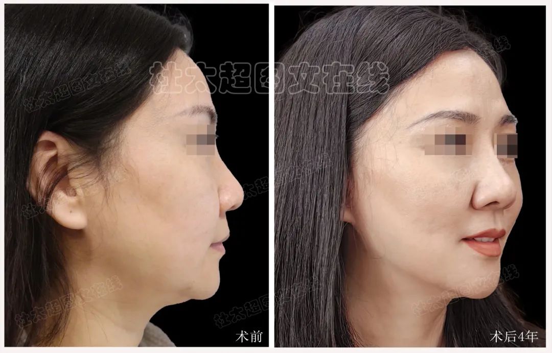 奇迹再现？拉皮手术背后的秘密，术后4年连自己都认不出了！