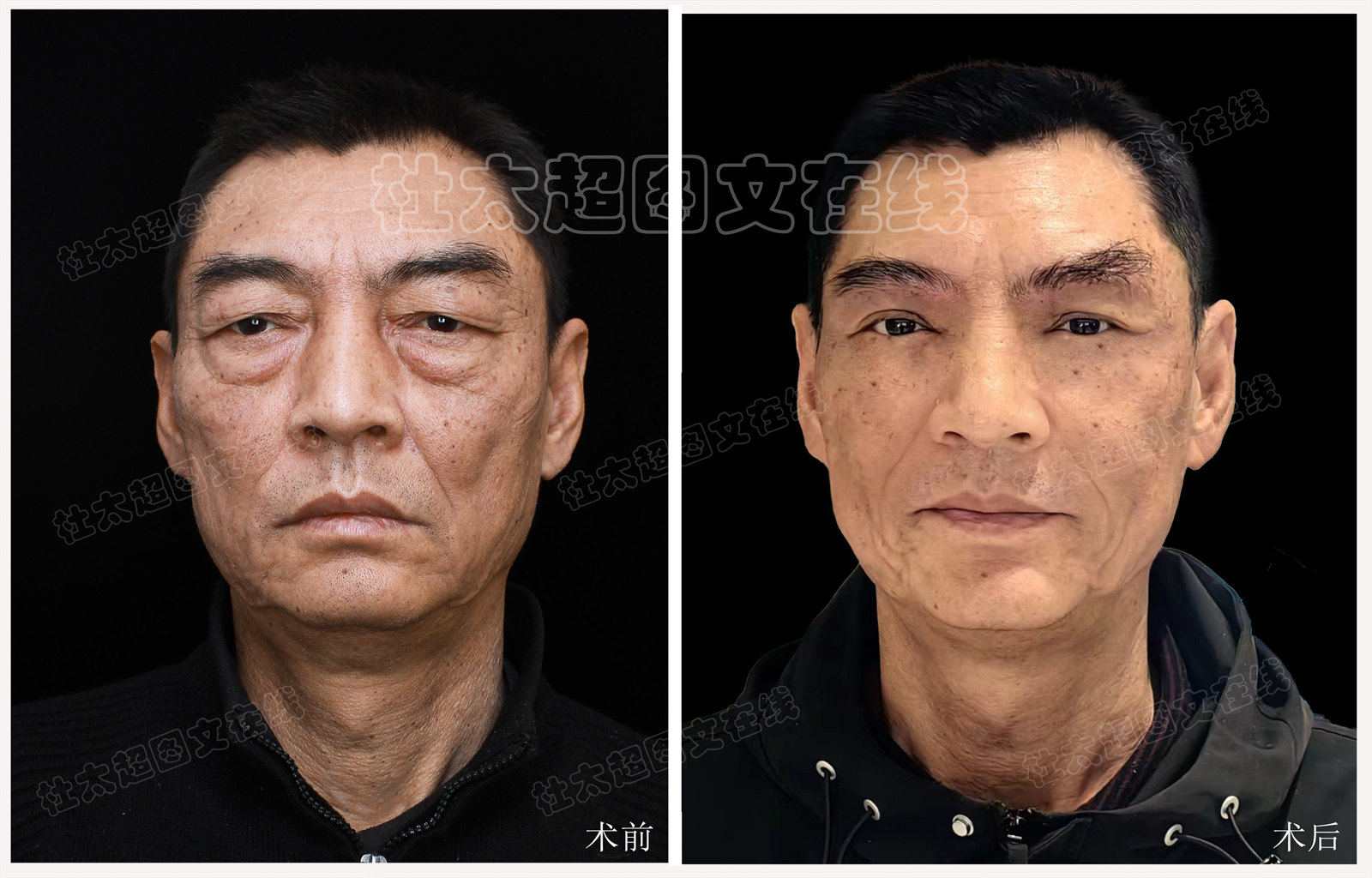 50+男士祛眼袋、提眉过程分享，术后抚平岁月痕迹！