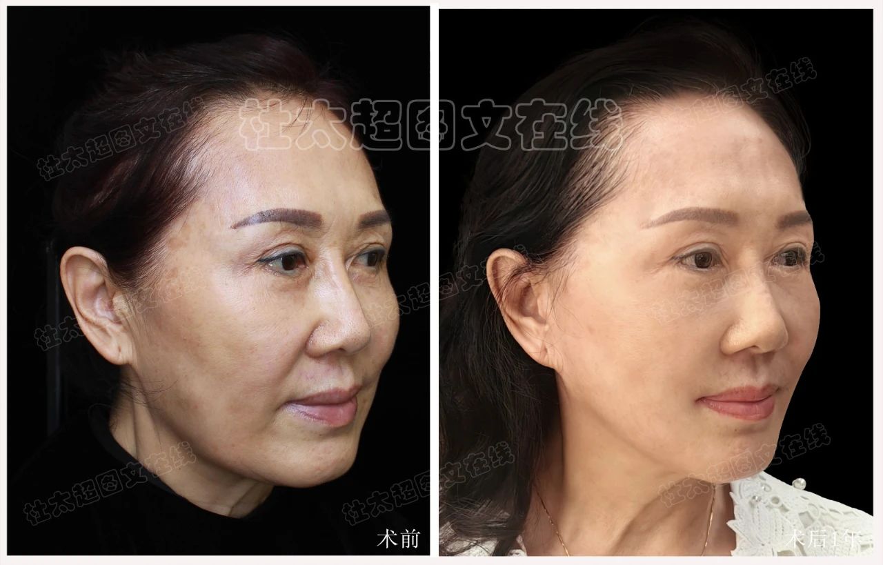 60岁做大拉皮，效果震撼朋友圈！她是怎么做到的？