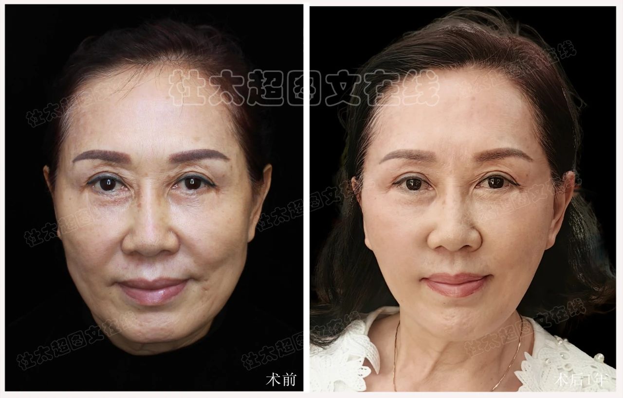 60岁做大拉皮，效果震撼朋友圈！她是怎么做到的？