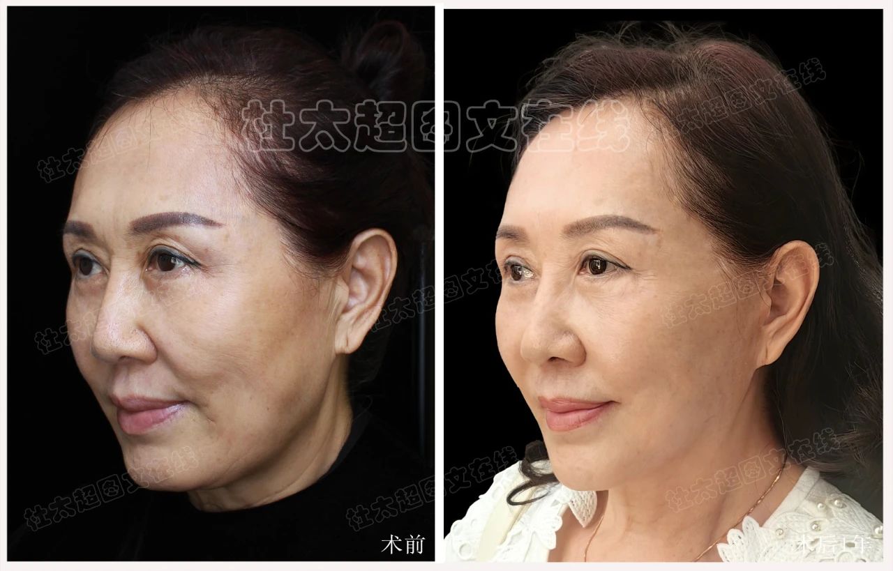 60岁做大拉皮，效果震撼朋友圈！她是怎么做到的？