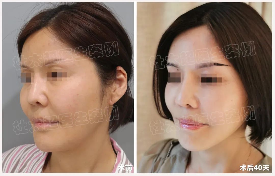 从‘岁月老葱’到‘时光嫩宠’，你到底通过拉皮手术干了什么！