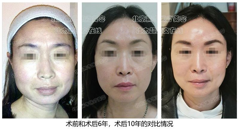 哇塞！时光倒流？惊叹拉皮手术不只是手术，10年不老的美丽秘密大公开！