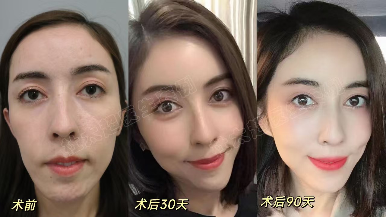 年龄不大想做拉皮手术可以吗？