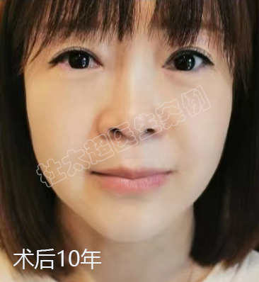 10年前做了拉皮手术的人，现在怎么样了？
