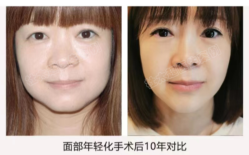 10年前做了拉皮手术的人，现在怎么样了？