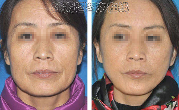 有这些情况，做拉皮可不可行？医生在线答疑