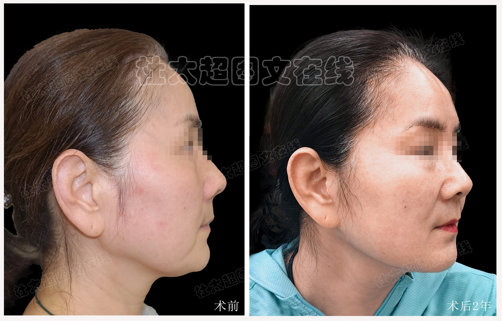 61岁挑战“全脸拉皮”，说说术后两个紧张时刻