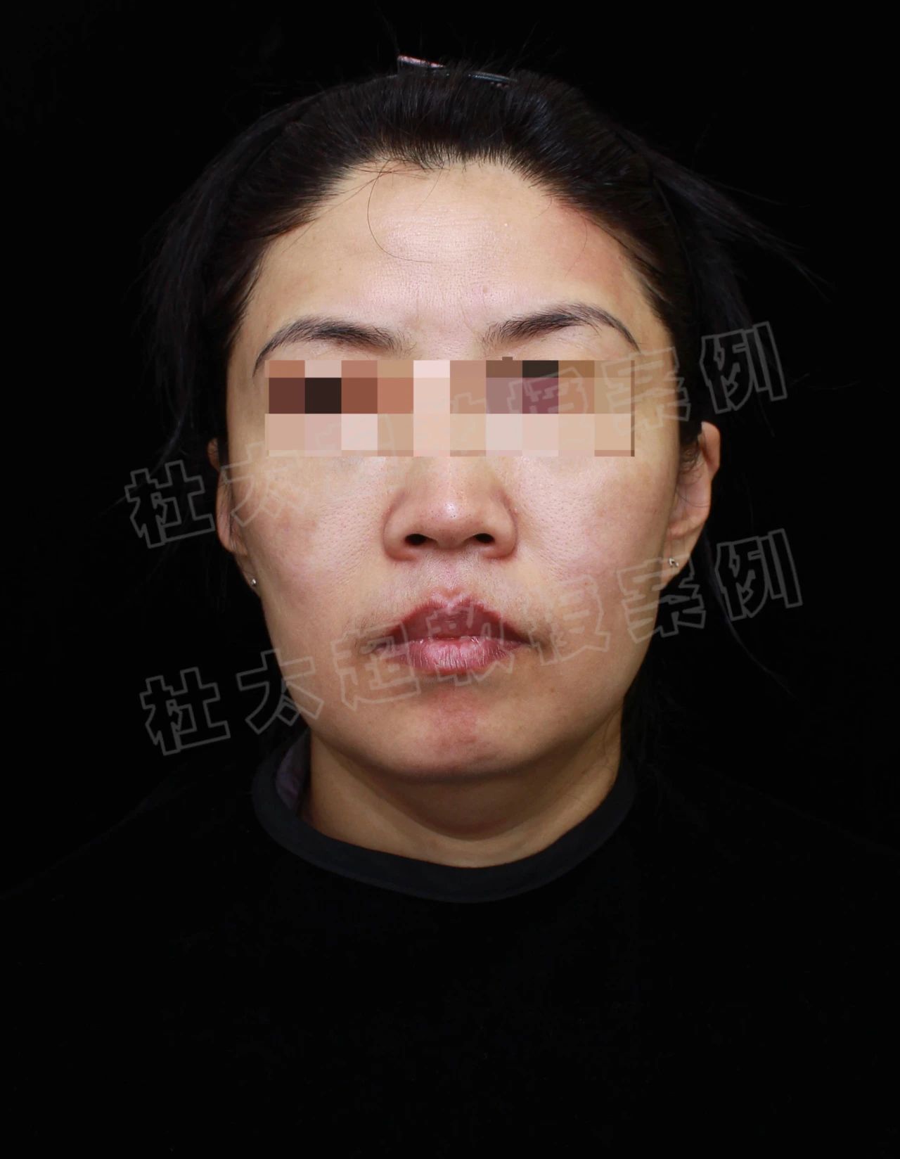 她说太丑!拉皮手术到底给她带来了什么,想要惊艳时光是痴心妄想? 她说太丑!拉皮手术到底给她带来了什么,想要惊艳时光是痴心妄想?