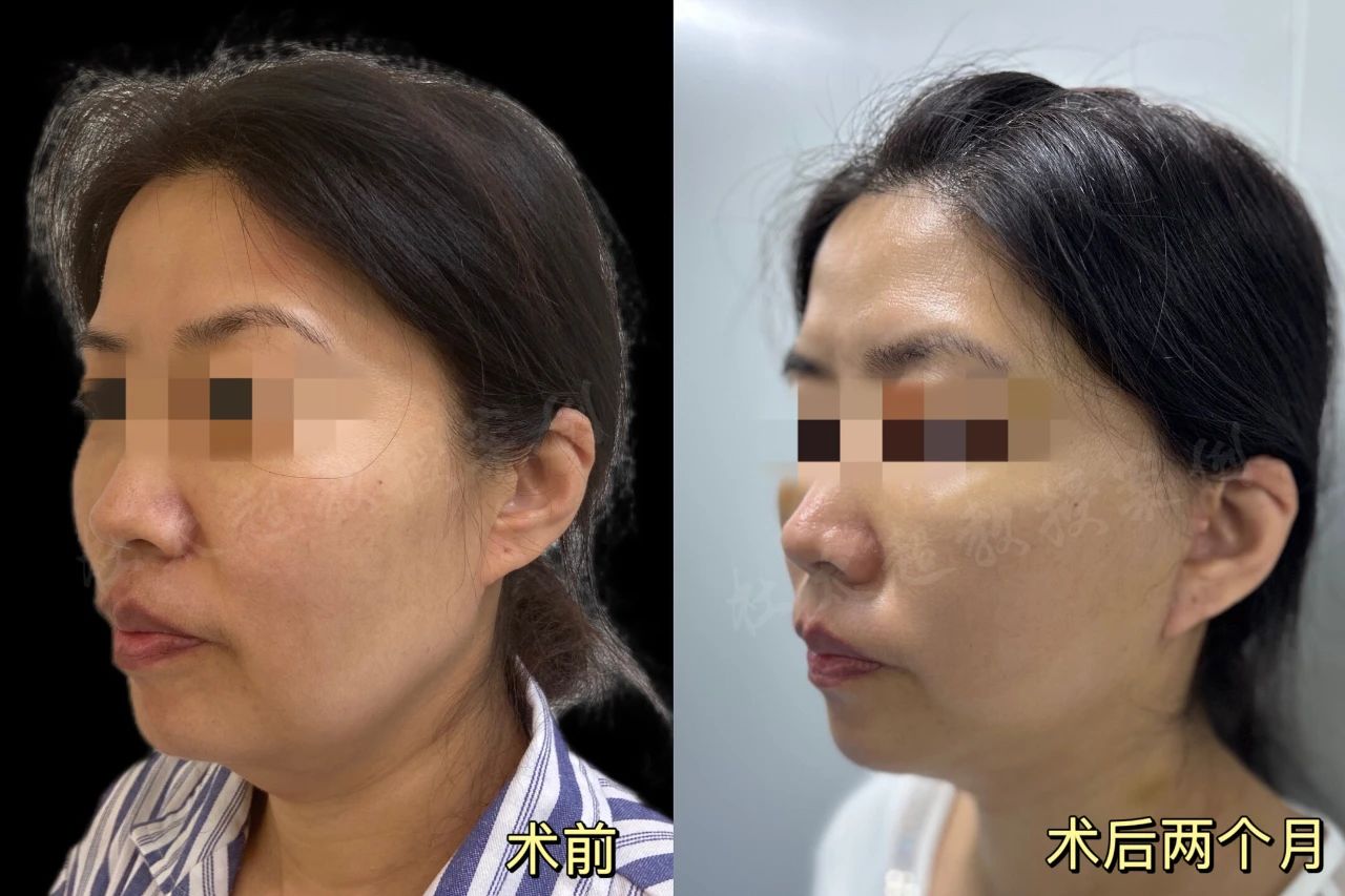 她说太丑!拉皮手术到底给她带来了什么,想要惊艳时光是痴心妄想? 她说太丑!拉皮手术到底给她带来了什么,想要惊艳时光是痴心妄想?