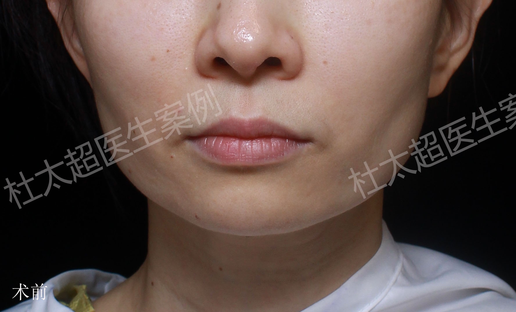 46岁做面部抗衰，不信线雕直接选择拉皮手术，原因竟是......