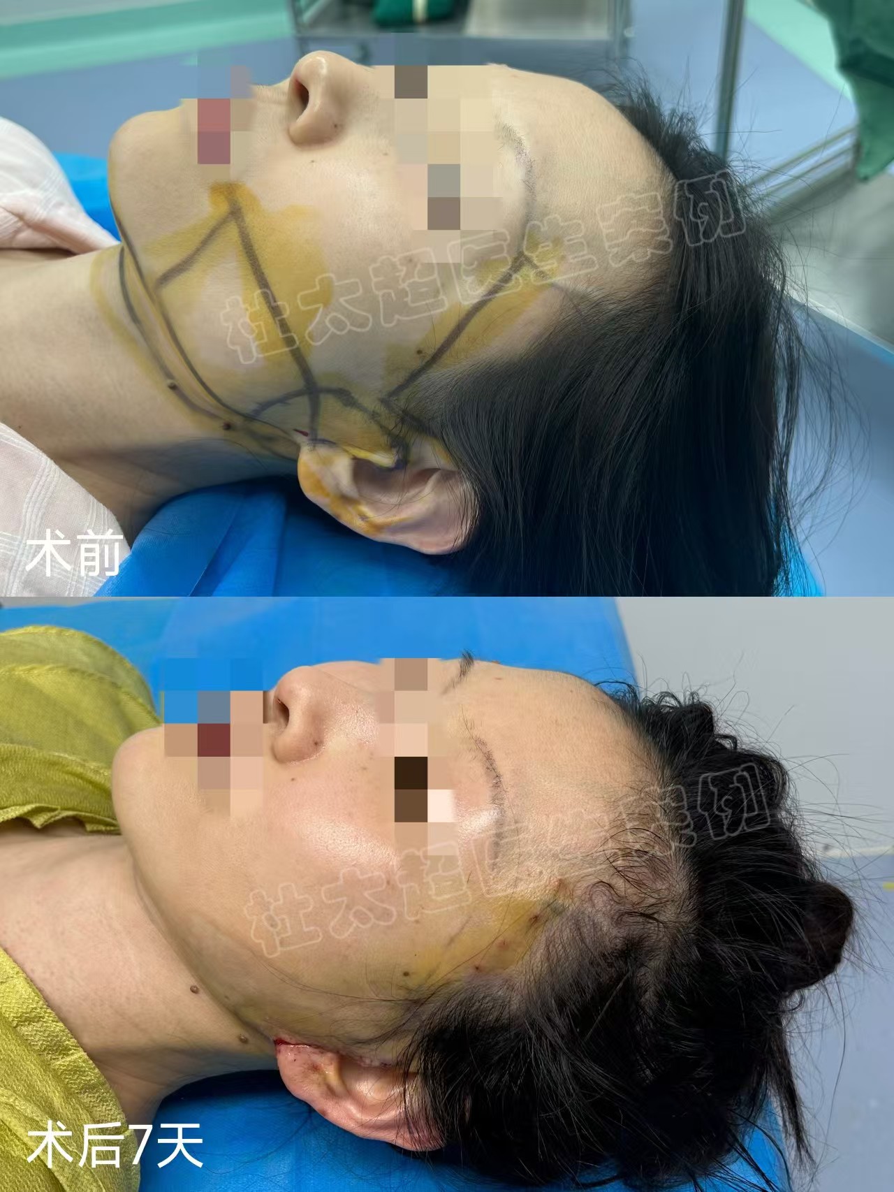 46岁做面部抗衰，不信线雕直接选择拉皮手术，原因竟是......