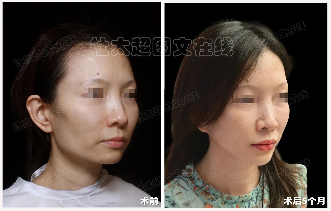 46岁整形成瘾?再次选择拉皮手术,是最后的雕琢还是美丽的重启? 46岁整形成瘾?再次选择拉皮手术,是最后的雕琢还是美丽的重启?