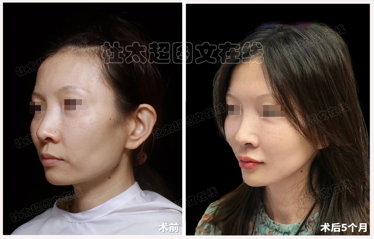 46岁整形成瘾?再次选择拉皮手术,是最后的雕琢还是美丽的重启? 46岁整形成瘾?再次选择拉皮手术,是最后的雕琢还是美丽的重启?