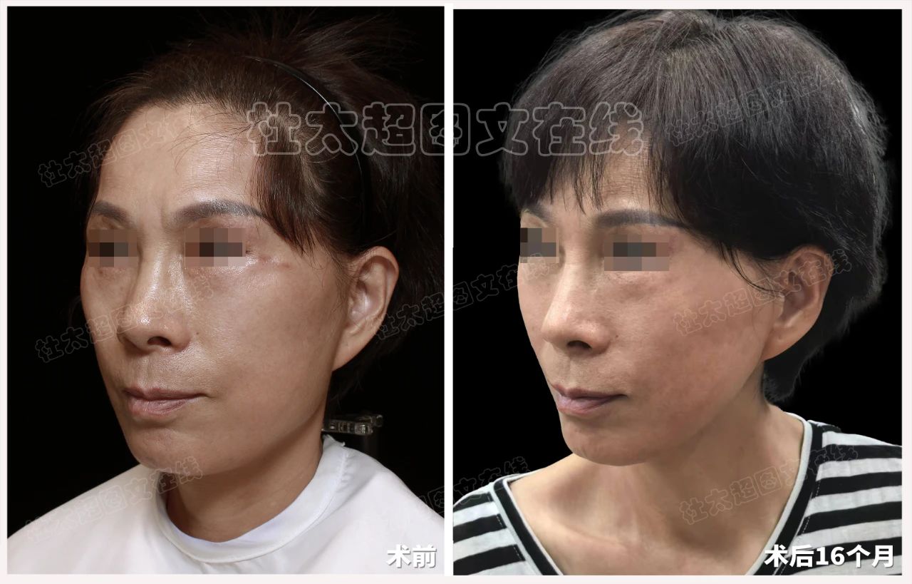 医生也会踩坑？低价拉皮坑太深，我的教训你别再犯！