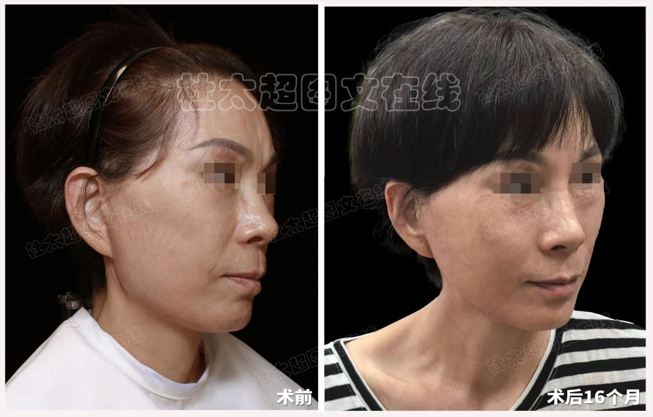 医生也会踩坑？低价拉皮坑太深，我的教训你别再犯！