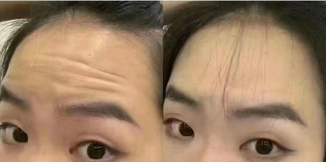 额部除皱和额部拉皮是一回事吗？专业解答来了