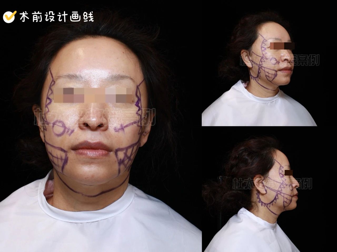 拉皮手术效果怎么样?这不是不要脸,是我追求美的权利!55岁又怎样? 拉皮手术效果怎么样?这不是不要脸,是我追求美的权利!55岁又怎样?