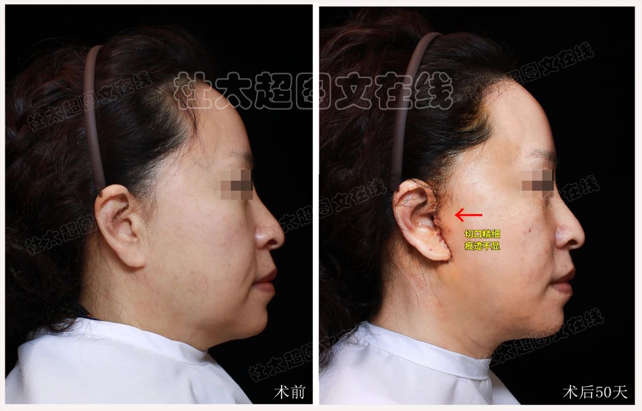 拉皮手术效果怎么样?这不是不要脸,是我追求美的权利!55岁又怎样? 拉皮手术效果怎么样?这不是不要脸,是我追求美的权利!55岁又怎样?