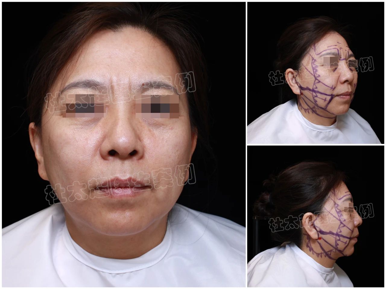 拉皮手术怎么样?70岁老妈神操作!力挺50岁女儿,拉皮手术大变样! 拉皮手术怎么样?70岁老妈神操作!力挺50岁女儿,拉皮手术大变样!