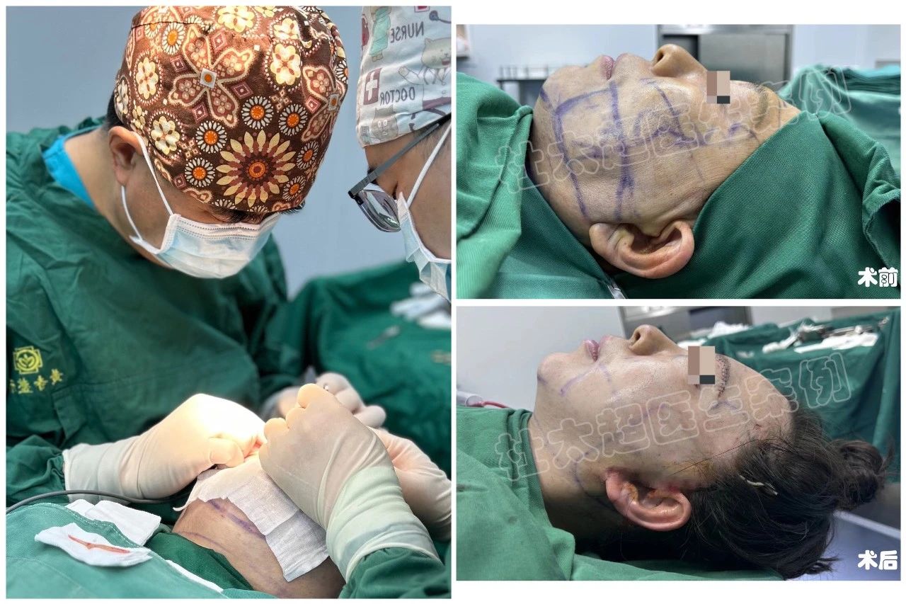 拉皮手术怎么样?70岁老妈神操作!力挺50岁女儿,拉皮手术大变样! 拉皮手术怎么样?70岁老妈神操作!力挺50岁女儿,拉皮手术大变样!