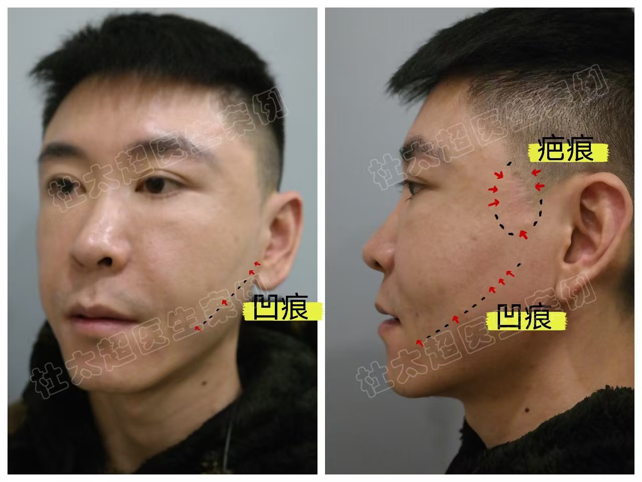 33岁男士做了拉皮手术,分享求美历程及效果 33岁男士做了拉皮手术,分享求美历程及效果