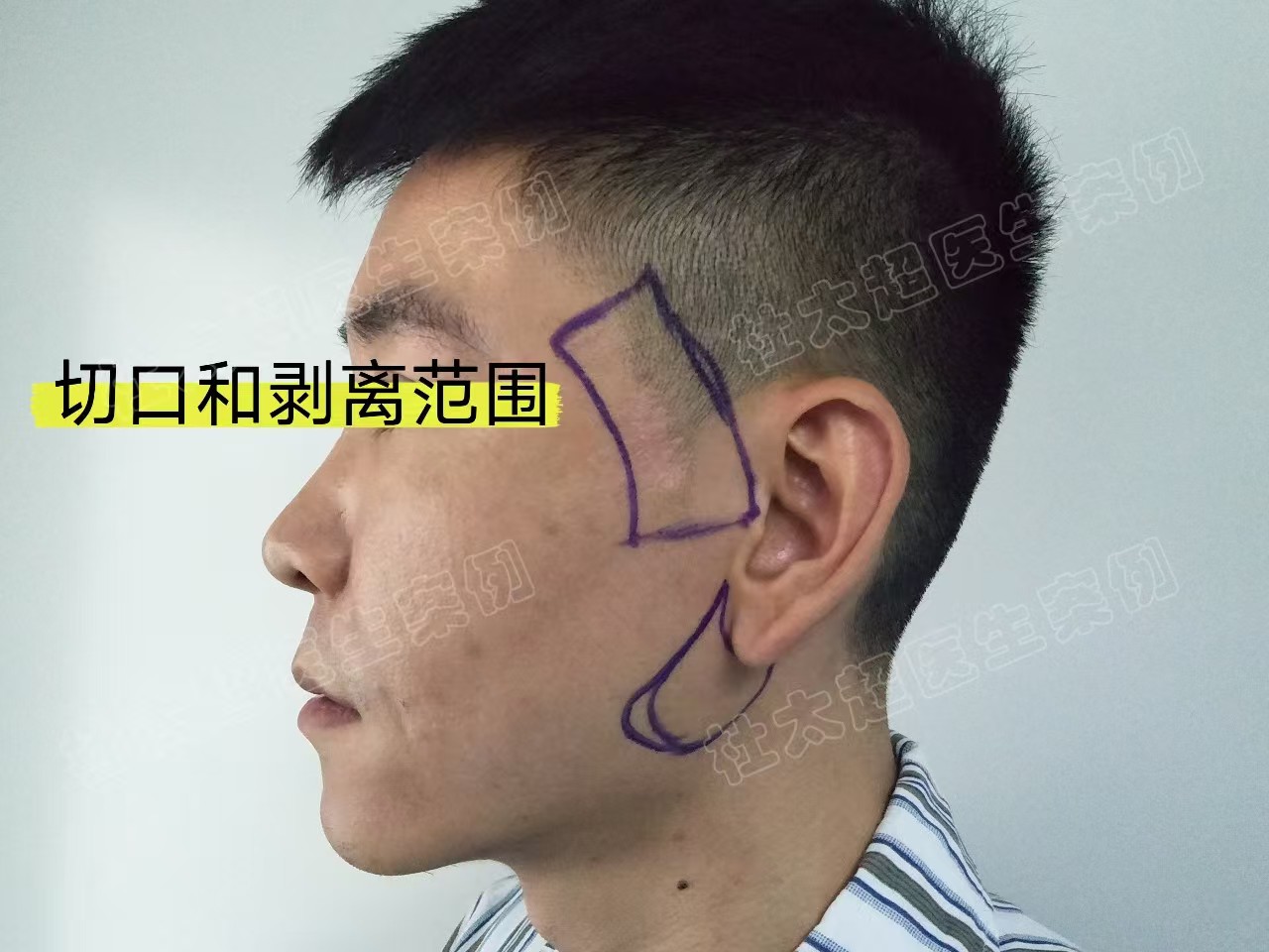 33岁男士做了拉皮手术,分享求美历程及效果 33岁男士做了拉皮手术,分享求美历程及效果