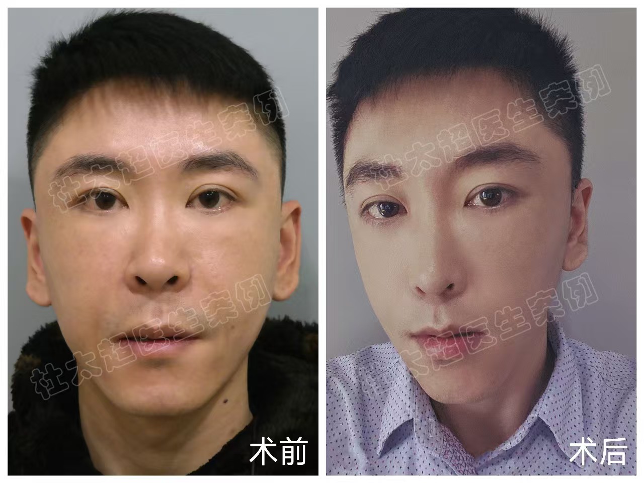 33岁男士做了拉皮手术,分享求美历程及效果 33岁男士做了拉皮手术,分享求美历程及效果