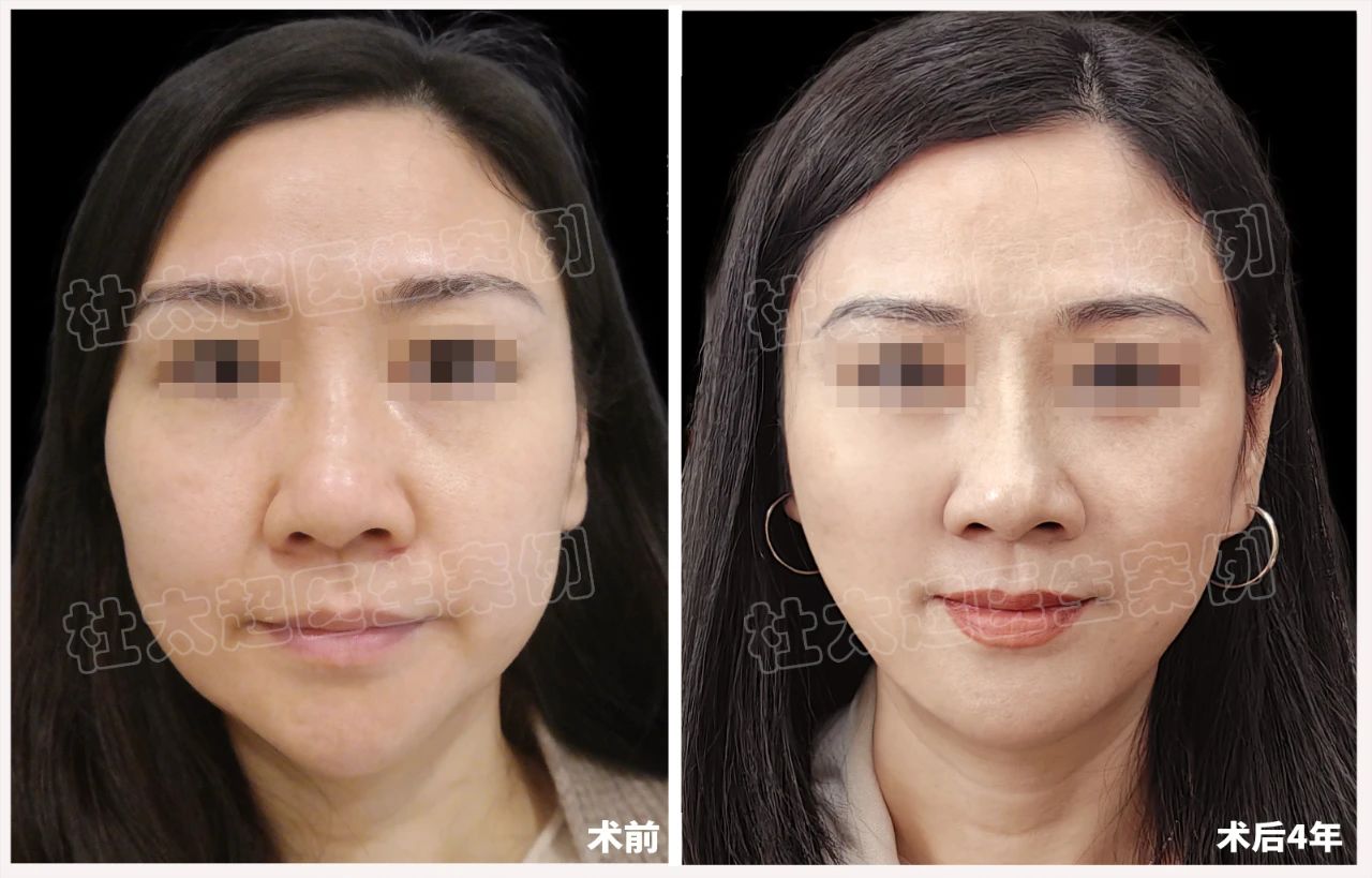 48岁女士拉皮手术后4年全过程深度分析! 48岁女士拉皮手术后4年全过程深度分析!