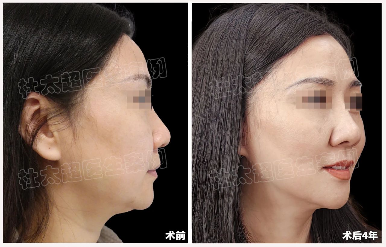 48岁女士拉皮手术后4年全过程深度分析! 48岁女士拉皮手术后4年全过程深度分析!