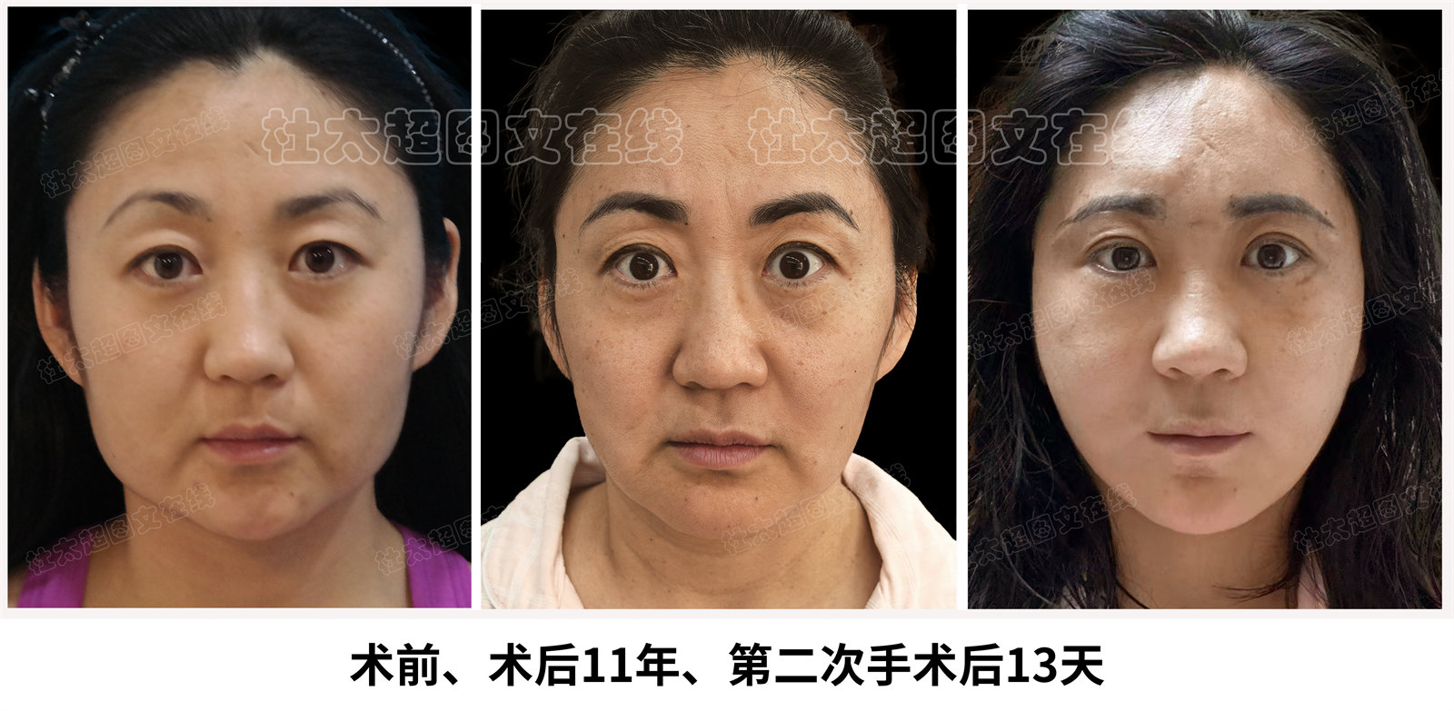 拉皮面部提升术后随访11年