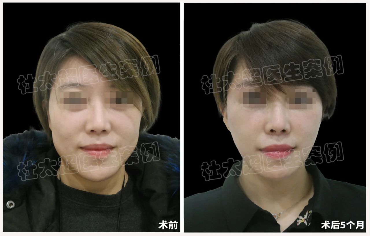 39岁女士caw小切口面部紧缩术术后5个月深度分析 39岁女士caw小切口面部紧缩术术后5个月深度分析