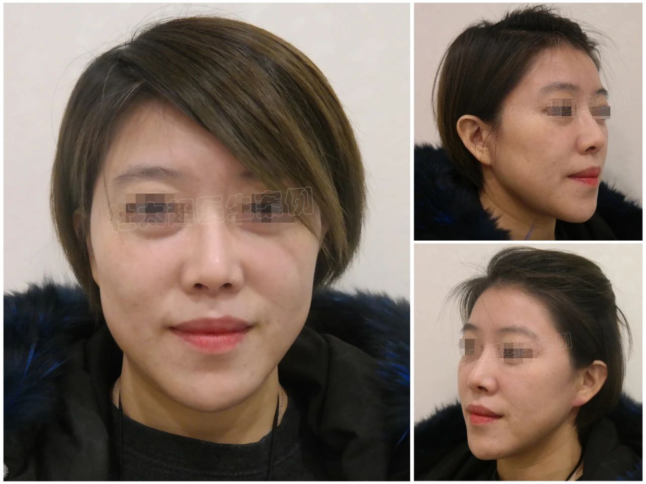 39岁女士caw小切口面部紧缩术术后5个月深度分析 39岁女士caw小切口面部紧缩术术后5个月深度分析