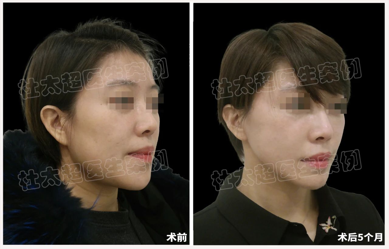39岁女士caw小切口面部紧缩术术后5个月深度分析 39岁女士caw小切口面部紧缩术术后5个月深度分析