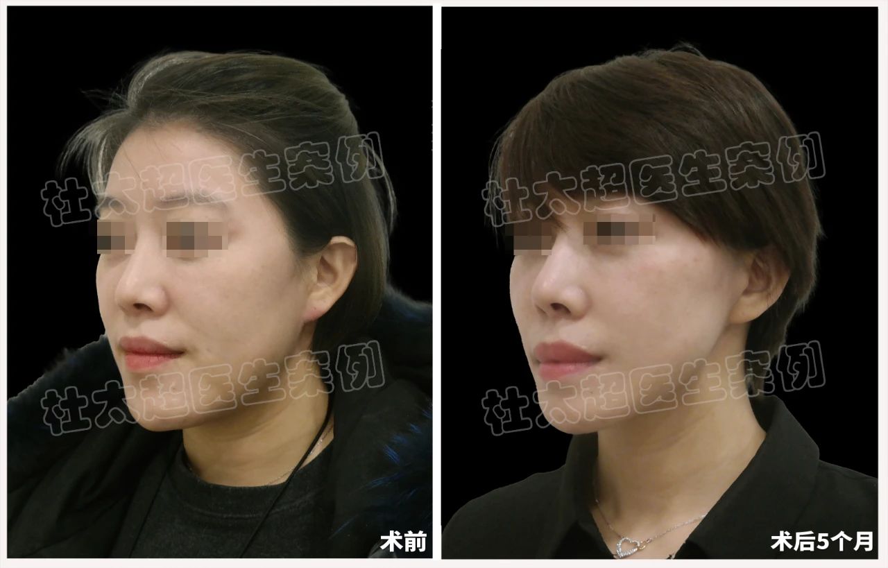 39岁女士caw小切口面部紧缩术术后5个月深度分析 39岁女士caw小切口面部紧缩术术后5个月深度分析