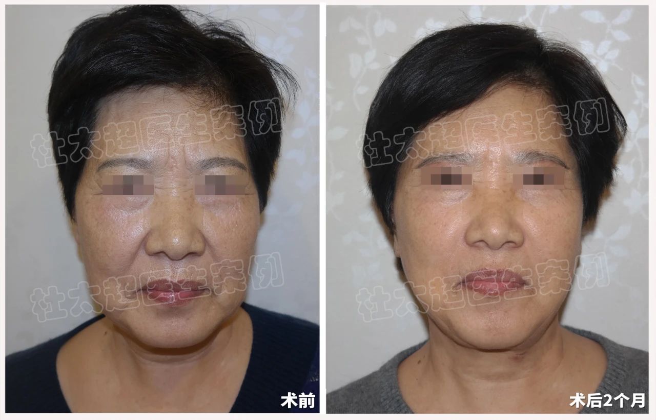 拉皮手术新趋势:64岁女士拉皮手术深度剖析 拉皮手术新趋势:64岁女士拉皮手术深度剖析