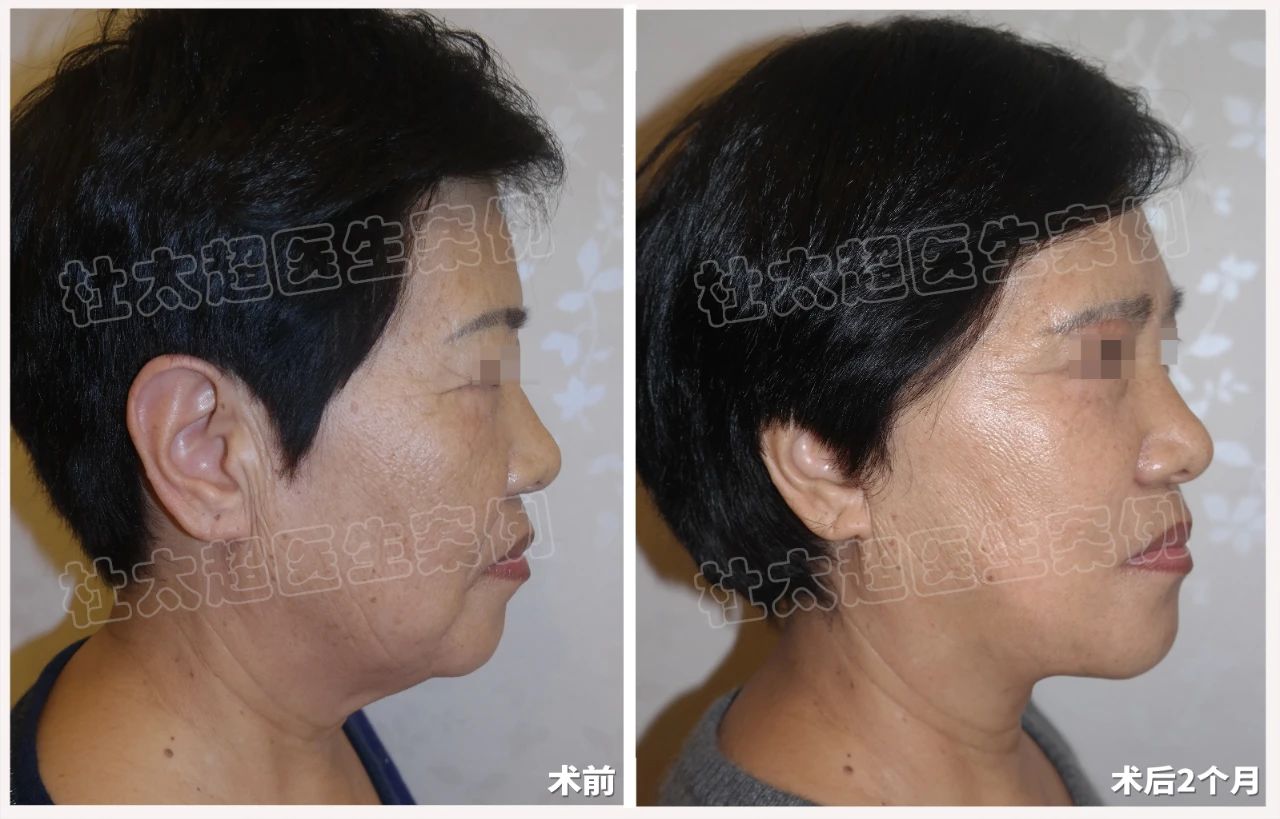 拉皮手术新趋势:64岁女士拉皮手术深度剖析 拉皮手术新趋势:64岁女士拉皮手术深度剖析