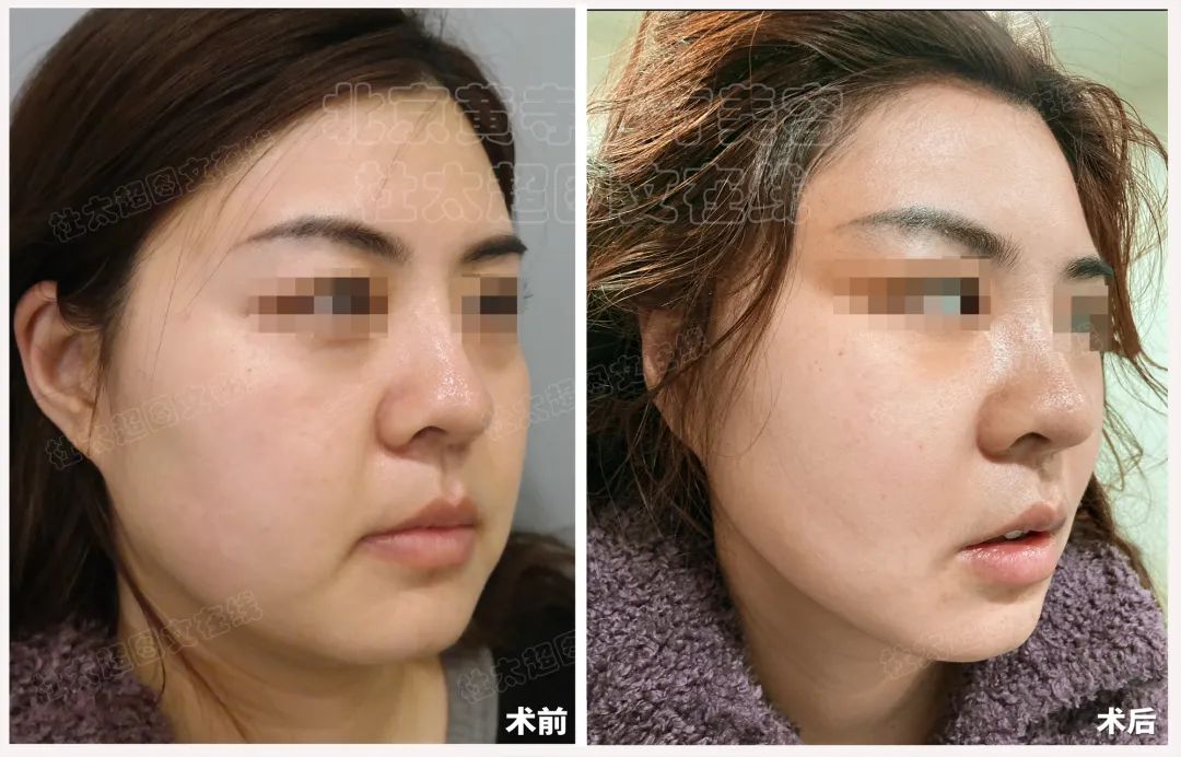 结果太震惊了!35岁就必须做拉皮手术?非手术方法真的无效吗? 结果太震惊了!35岁就必须做拉皮手术?非手术方法真的无效吗?