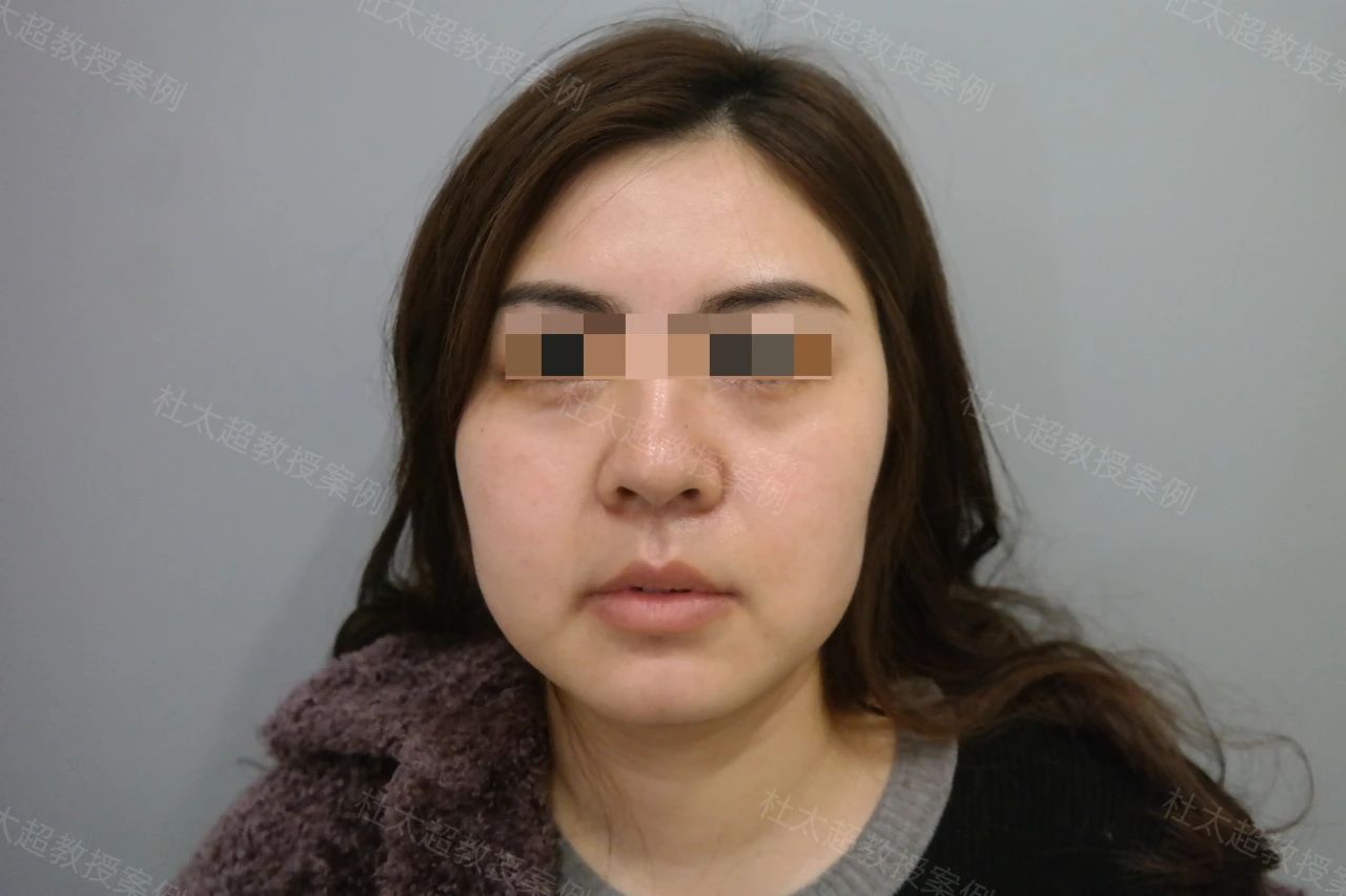 结果太震惊了!35岁就必须做拉皮手术?非手术方法真的无效吗? 结果太震惊了!35岁就必须做拉皮手术?非手术方法真的无效吗?